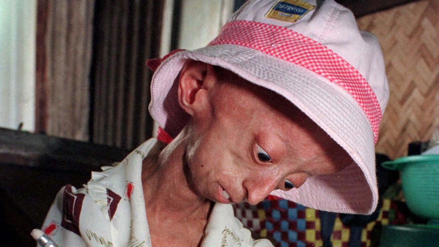 Progeria