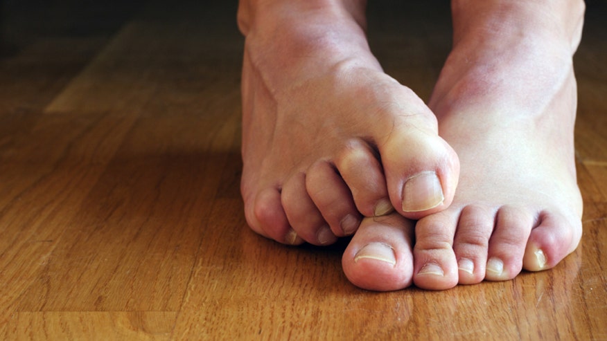 Toenail Fungus