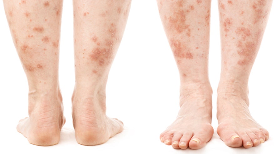 Treats Psoriasis