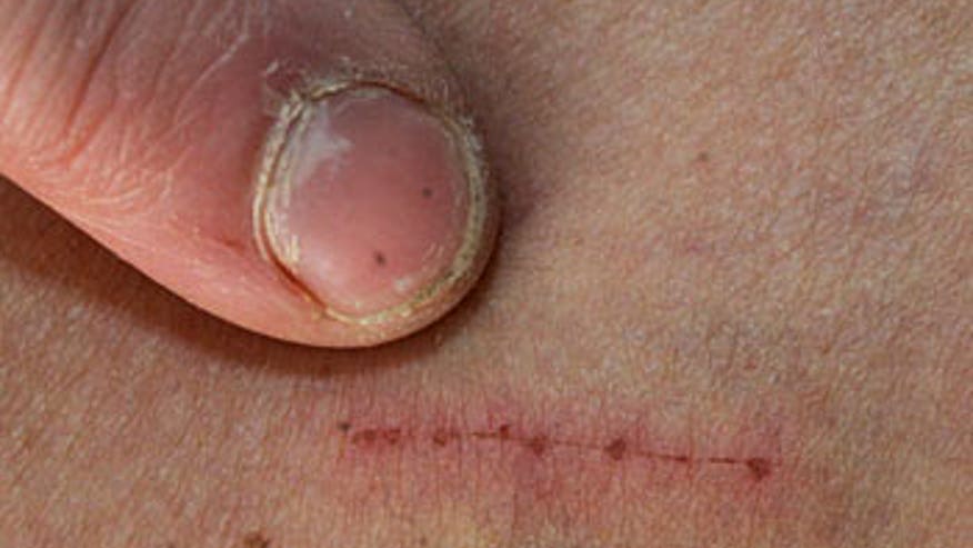 Morgellons Disease