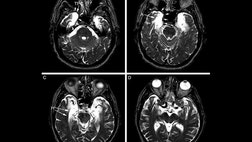 The brain of a famous patient known only as E.P., whose complete inability to form new memories puzzled researchers for nearly two decades, has now been analyzed