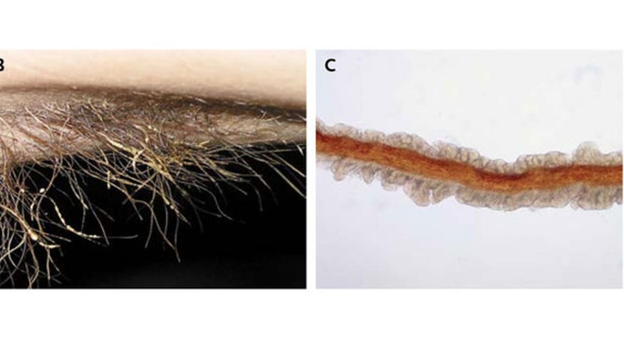 armpit-hair-infection