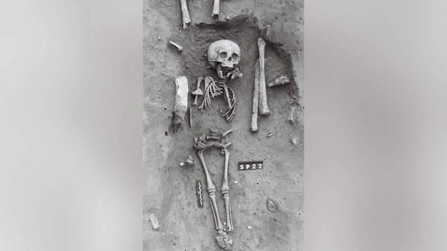 down-syndrome-skeleton