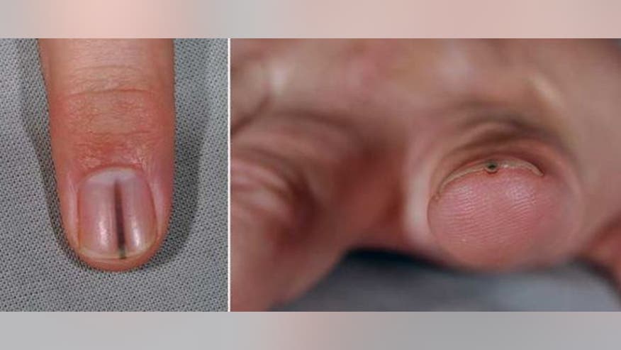 nail-tumor-140206