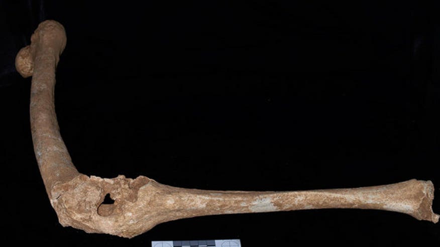philip-leg-bone