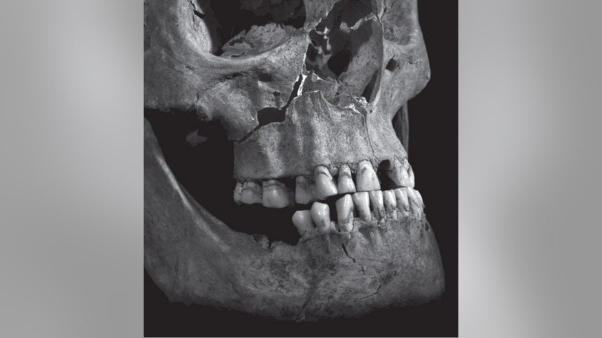 richard-iii-injuries-2