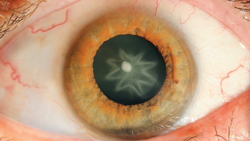 star-cataract-NEJM-130403