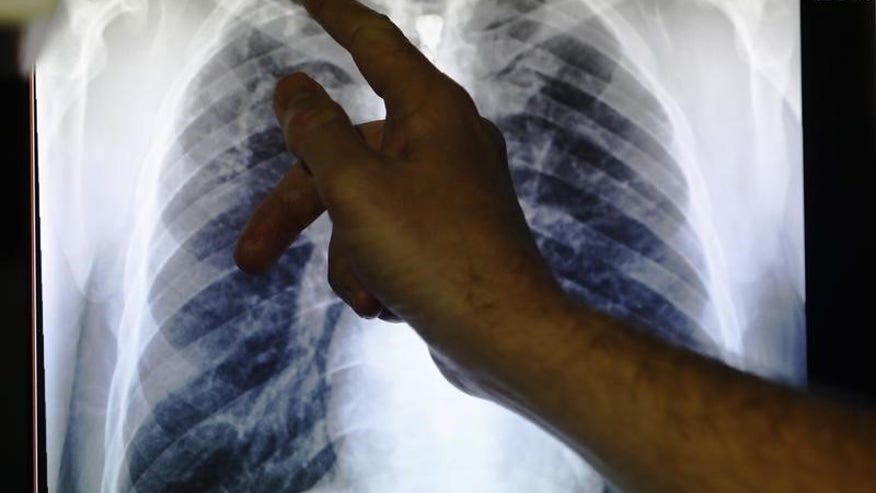 Tuberculosis now rivals AIDS as leading cause of death: WHO