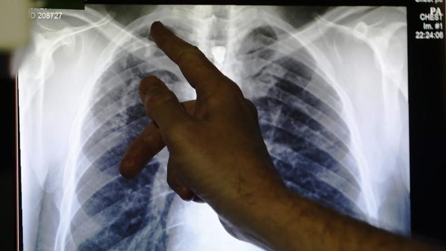 Tuberculosis now rivals AIDS as leading cause of death: WHO