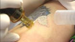 At , Julie Miranda knew that tattoo she had gotten when she was  years old wasn't right for her anymore. The lengthy tattoo removal process initially discouraged her, but a new procedure can drastically cut the time it takes to remove a tattoo