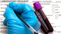An increase in HIV infections among the Navajo people in Gallup, N.M. has the medical community concerned over a possible epidemic.