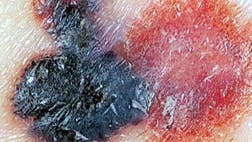 >Malignant skin cancers develop in different areas of the head and neck in men and women. 