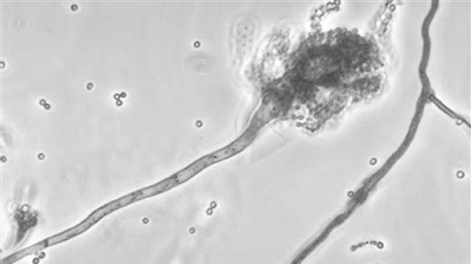 100712_anhq_meningitis_640.jpg
