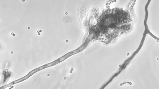 101812_serrie_meningitis_640.jpg