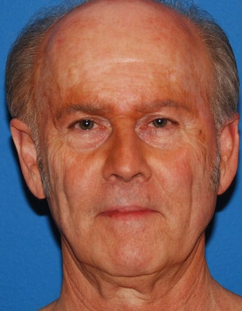 0_21_350_Larry_Before