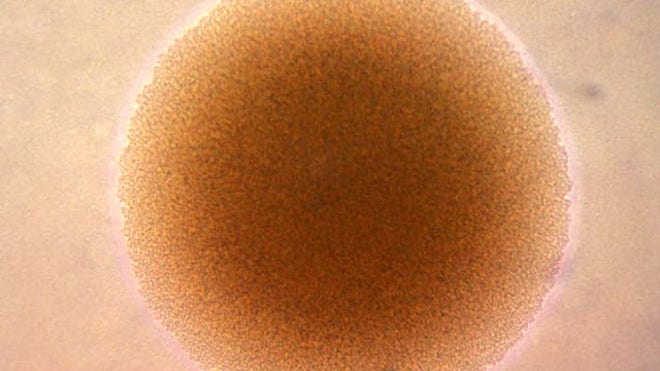 gonorrhea
