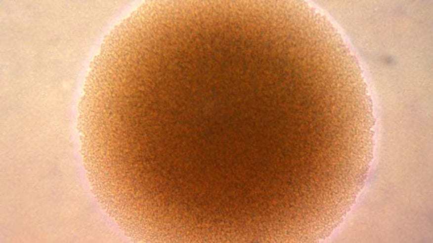 gonorrhea