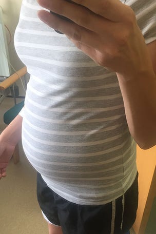 ‘Baby bump’ a massive cyst