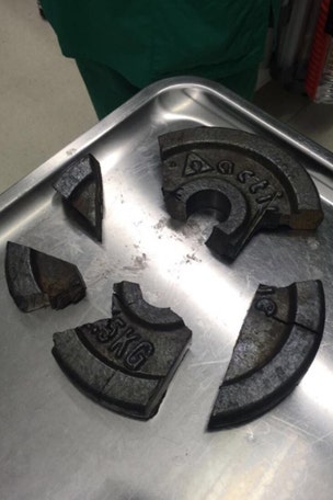 Man gets WHAT stuck in dumbbell?
