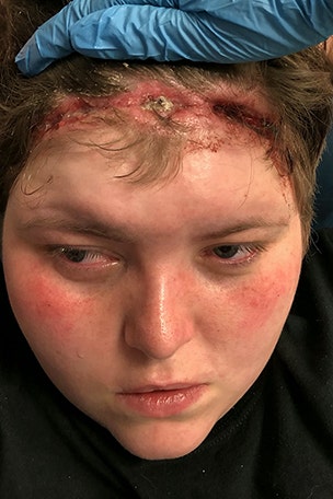 Woman's head gushed blood from improper weave