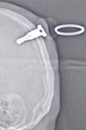 Man cheats death after fight