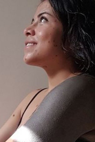 Woman tormented over birthmarks