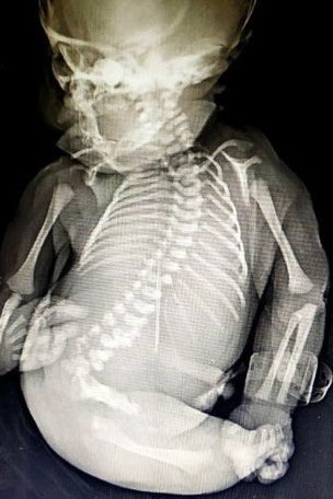 'Mermaid syndrome' baby born, dies