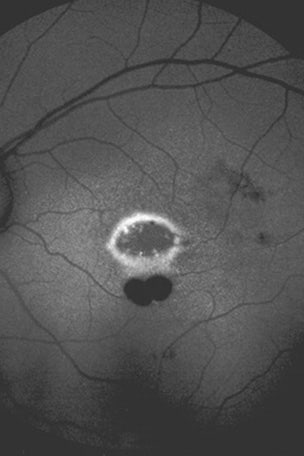 Laser burns hole in boy's eye