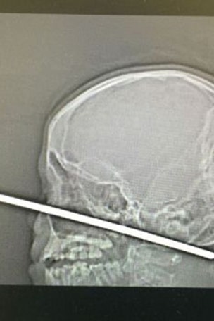 Boy survives meat skewer through face