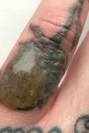 Tattoo removal gone wrong