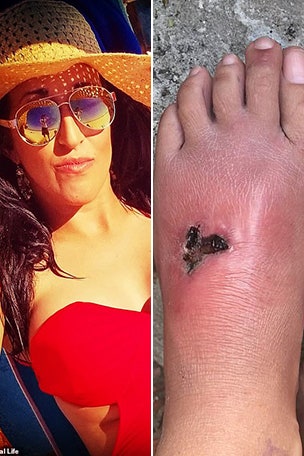 Shark attack victim nearly loses foot