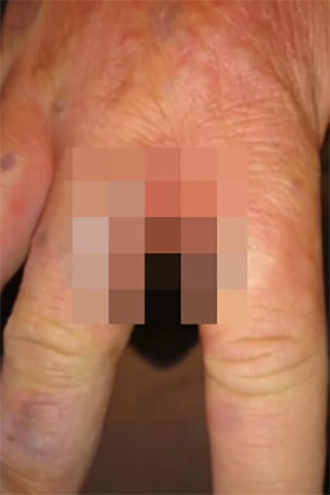 Hiker suffers from 'zombie skin'