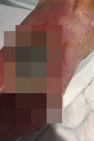GRAPHIC: Odd treatment saved man's life