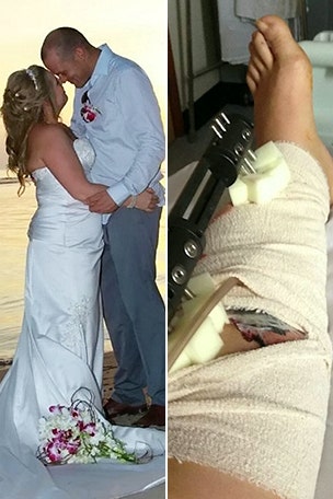 Bride nearly lost leg hours after wedding