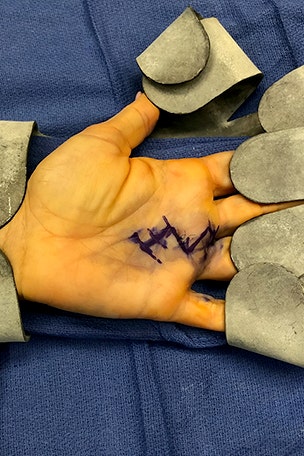 'Avocado hand' mishap ends in surgery