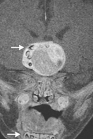 Infant's rare tumor had TEETH