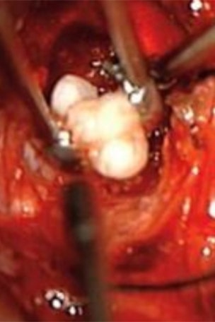 Infant's tumor had THIS inside