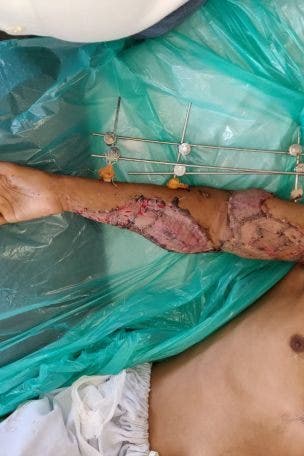 GRAPHIC PHOTOS: Man's arm severed by train