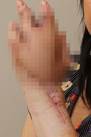 GRAPHIC PIC: Cat scratch led to THIS