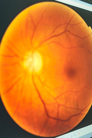 PHOTOS: He found a tick in his EYE