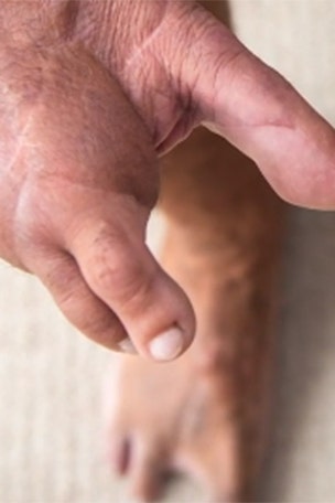 Dad’s toes replace lost fingers