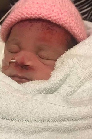 Mom claims C-section scarred newborn