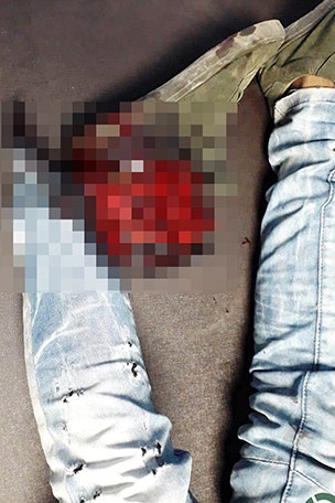 Man's foot REATTACHED after horror injury