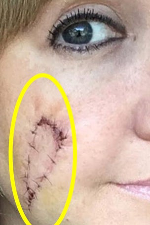 Woman: People thought it was a dog bite