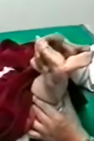 Tragic teen born with Mermaid Syndrome