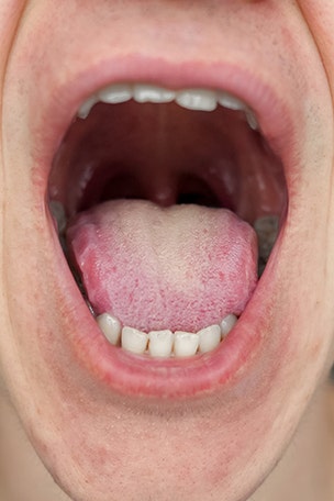 Why did this man's taste buds disappear?