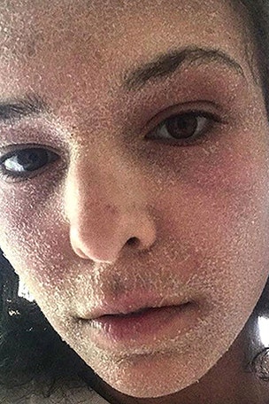 Dead skin filled sheets like a 'SANDPIT'