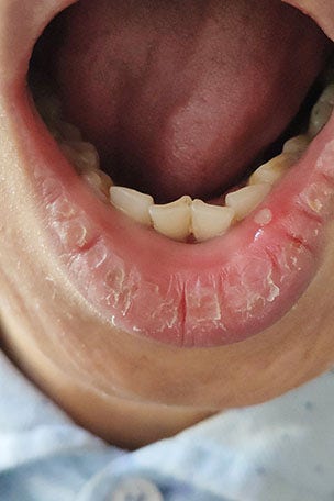 Is it a canker sore?