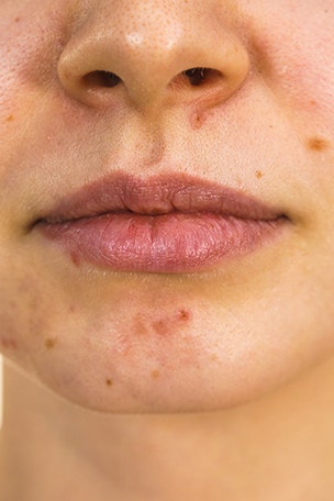 What causes acne?