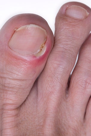 Is your toenail infected?